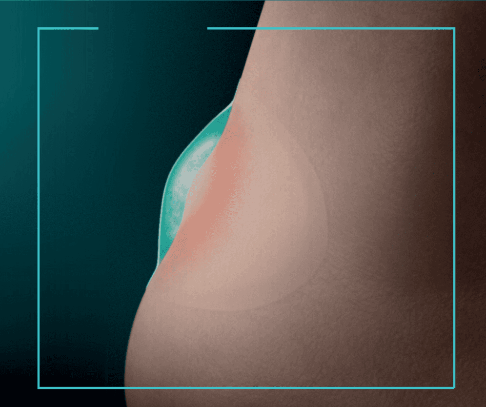 Blisterplaster on heel